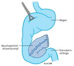 Situation nach Pankreas-Linksresektion