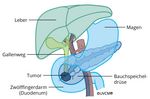 Bauchspeicheldrüsentumor (Pankreastumor) im Kopfsegment